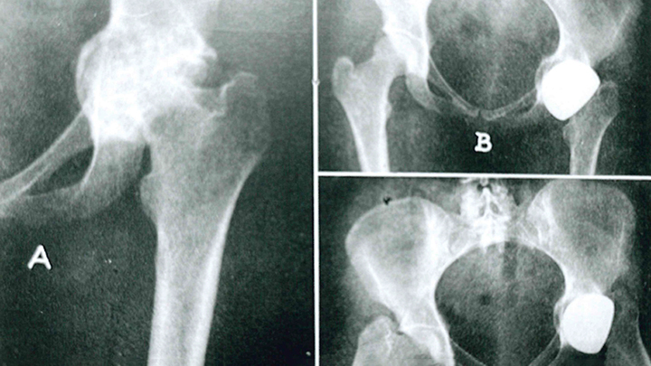  Three x-ray views of hip joints with implants, taken from different views